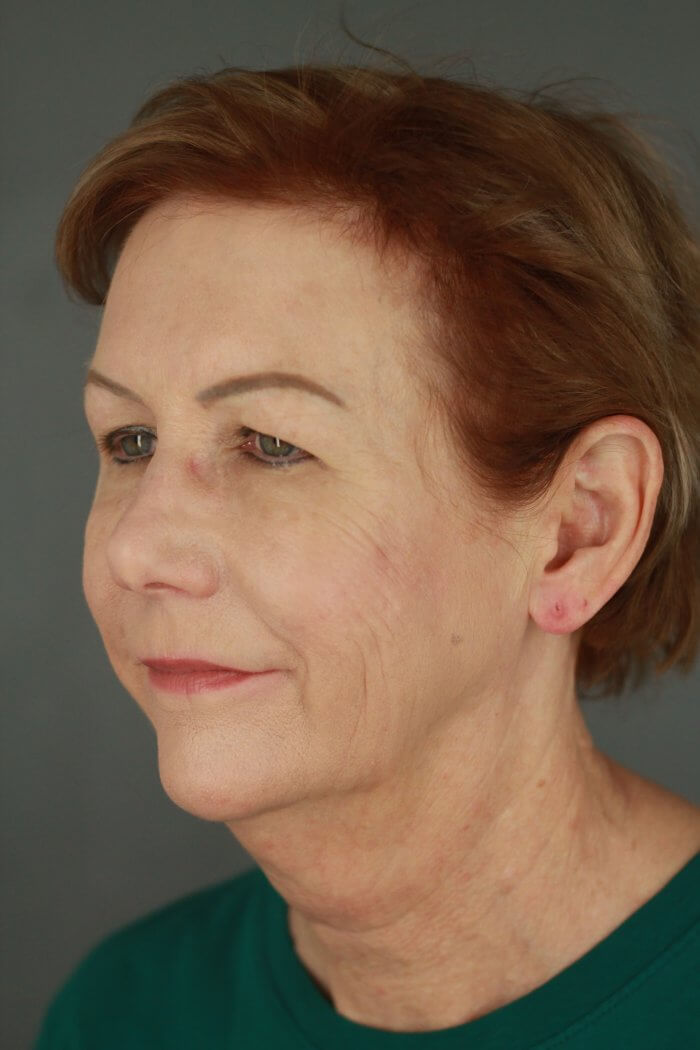 Case--3957 | Before Lip Lift 2