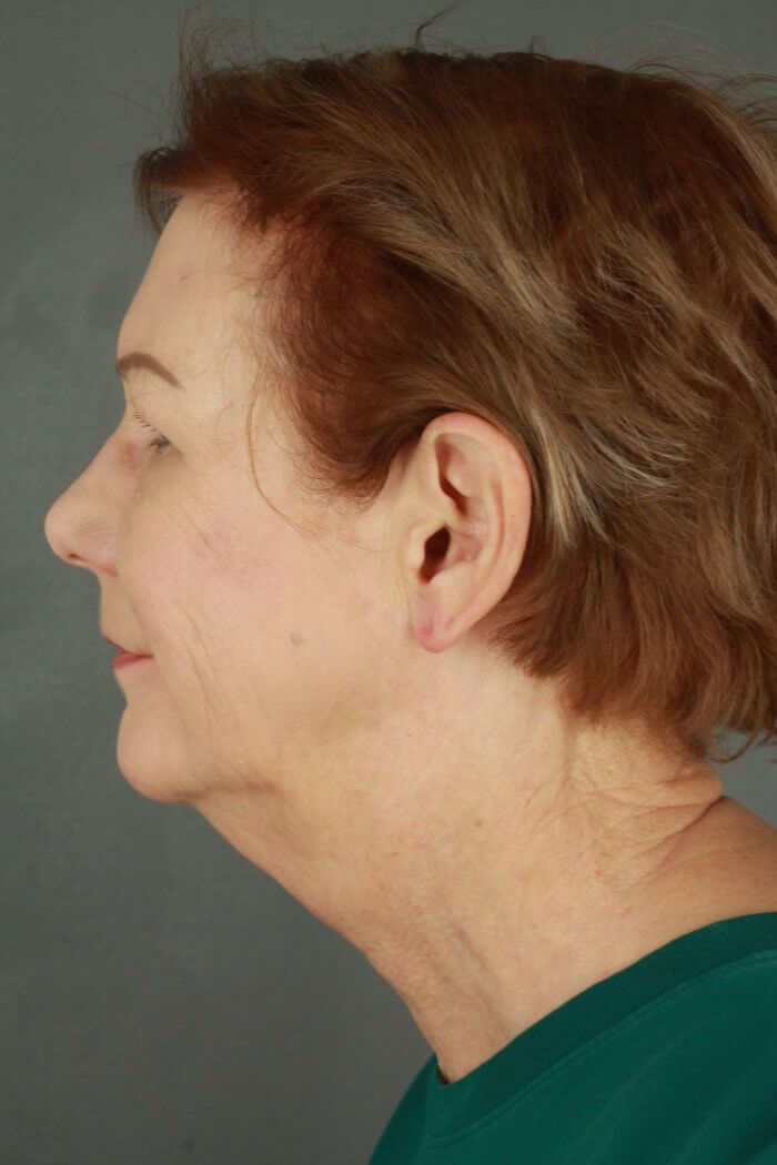 Case--3957 | Before Lip Lift 5