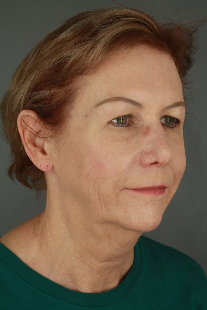 Case--3957 | Before Lip Lift 3