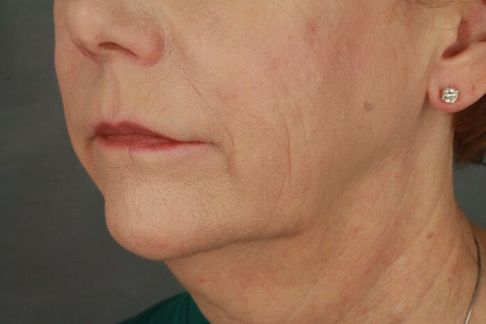 Case--3957 | Before Lip Lift 8