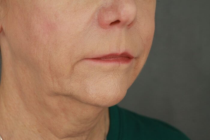 Case--3957 | Before Lip Lift 9