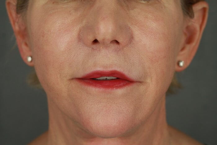 Case--3957 | After Lip Lift 7