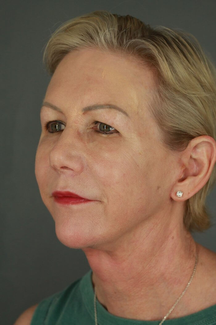 Case--3957 | After Lip Lift 2