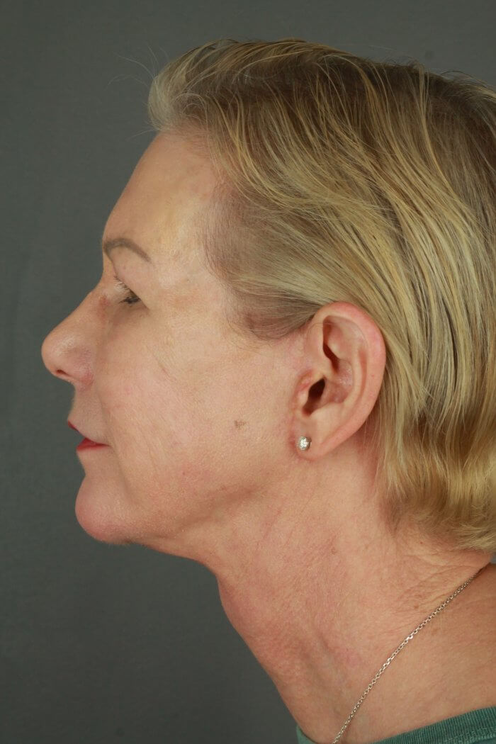 Case--3957 | After Lip Lift 5