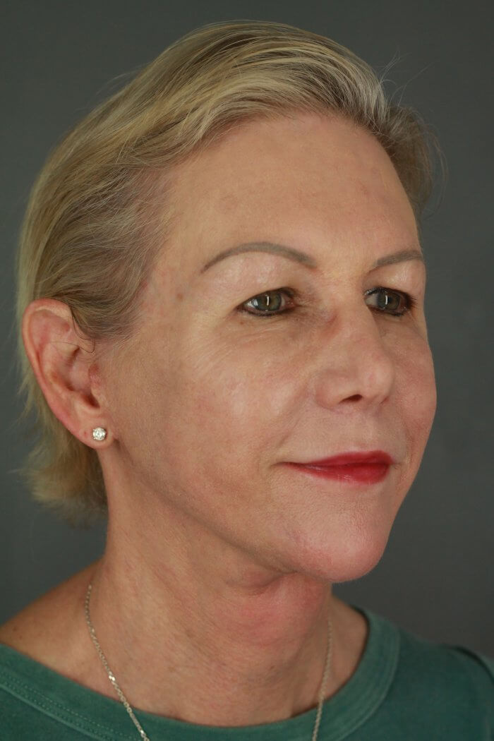 Case--3957 | After Lip Lift 3