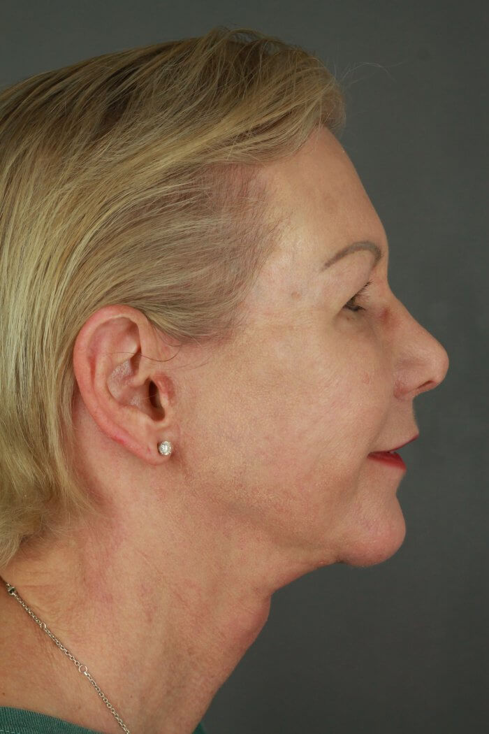 Case--3957 | After Lip Lift 4