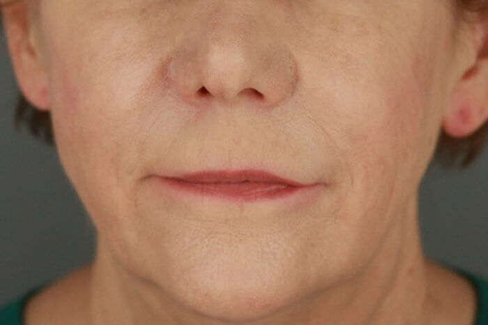 Case--3957 | Before Lip Lift 6