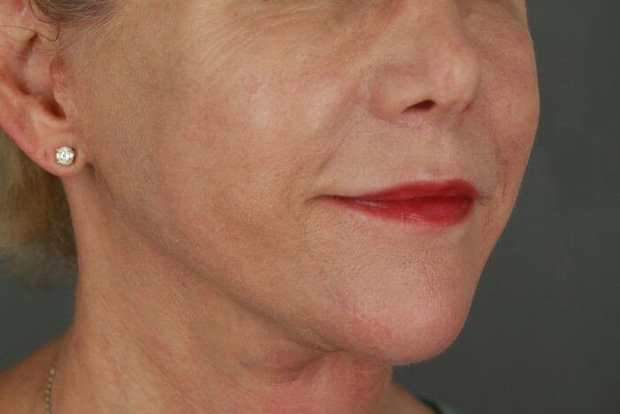 Case--3957 | After Lip Lift 9