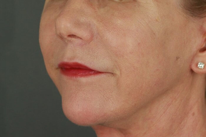 Case--3957 | After Lip Lift 8