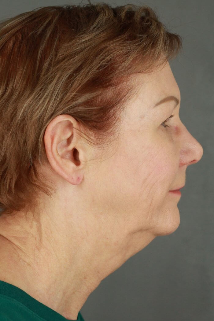 Case--3957 | Before Lip Lift 4