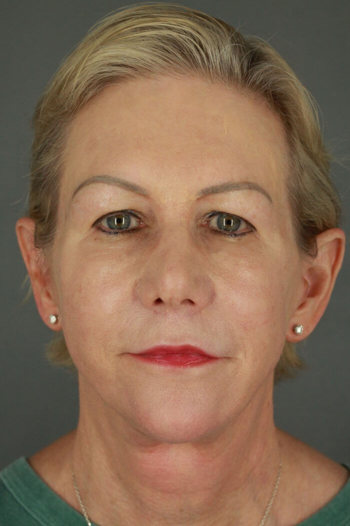 Case--3957 | After Lip Lift