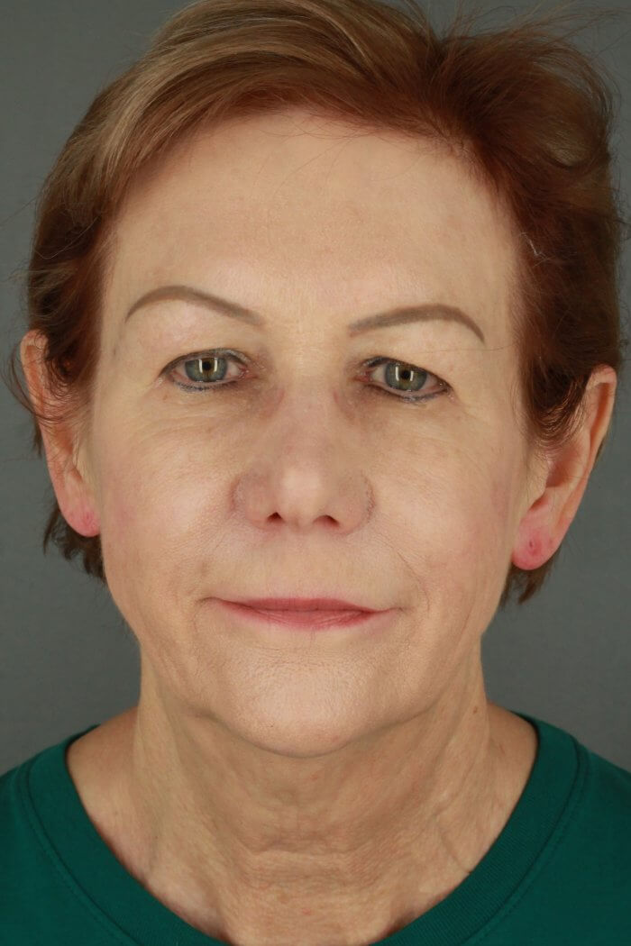 Case--3957 | Before Lip Lift