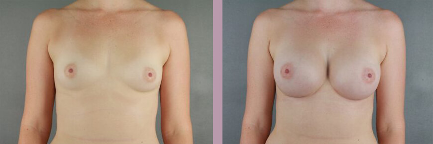 Breast Augmentation - Before and After Patient Results - 1