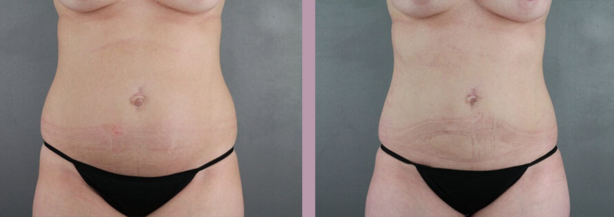 Liposuction - Before and After Patient Results - 2