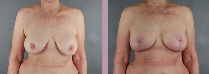 Breast Lift - Before and After Patient Results - 3