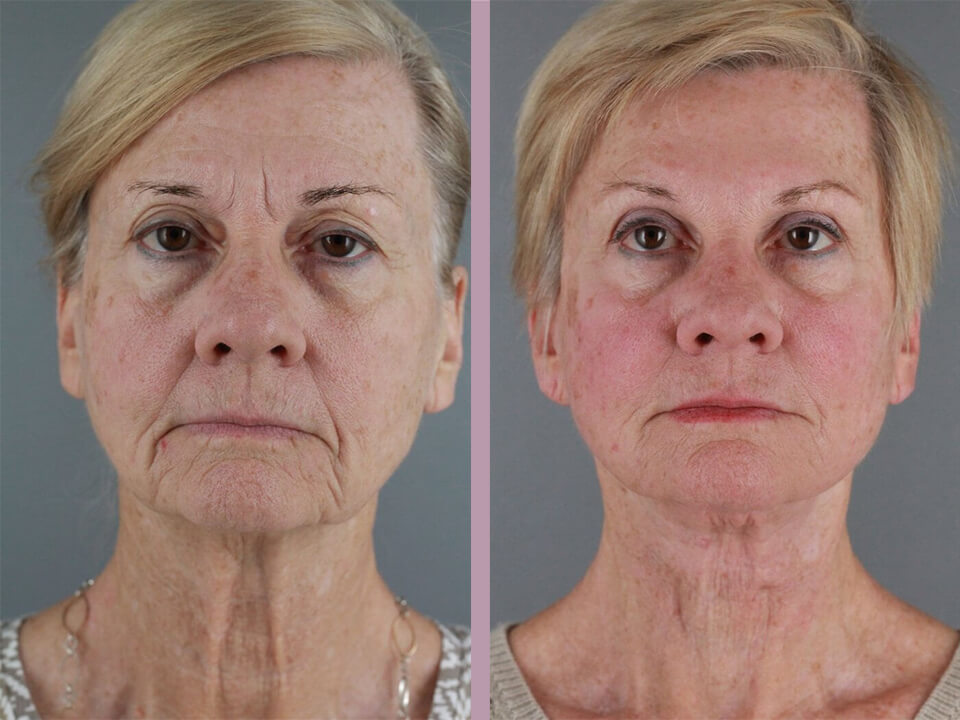 Blepharoplasty - Before and After Patient Results - 2