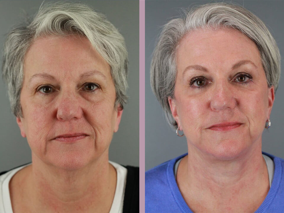 BOTOX® Cosmetic - Before and After Patient Results - 1