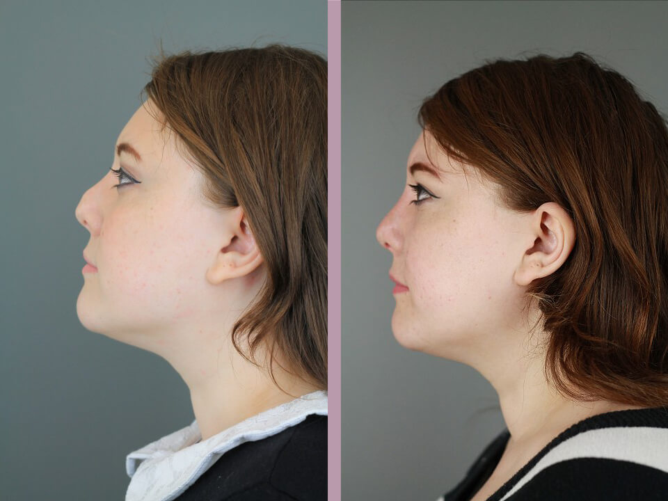 Rhinoplasty - Before and After Patient Results - 1
