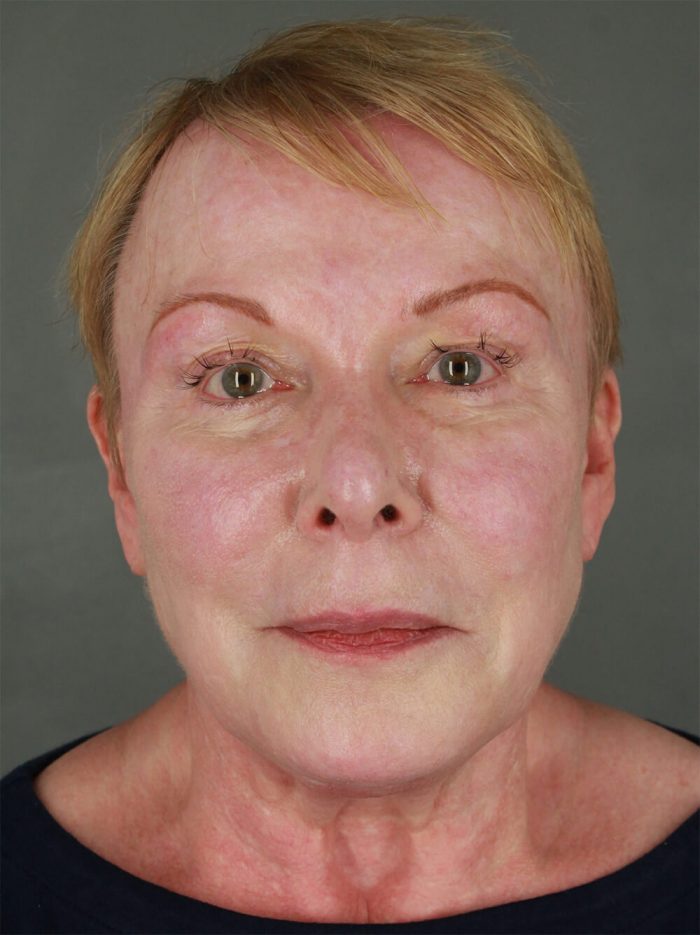 Case--7780 | Before Lip Lift