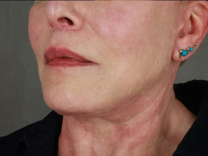 Case--7780 | After Lip Lift 2