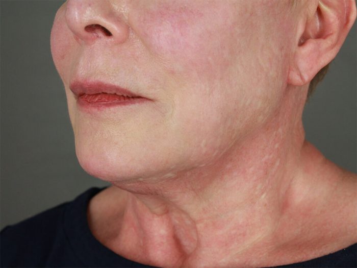 Case--7780 | Before Lip Lift 2