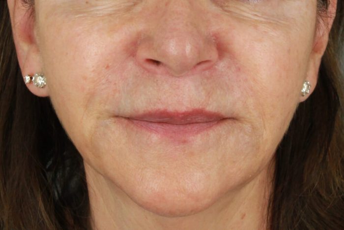 Case--4062 | After Lip Lift