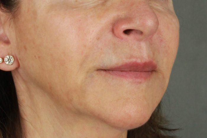 Case--4062 | After Lip Lift 2