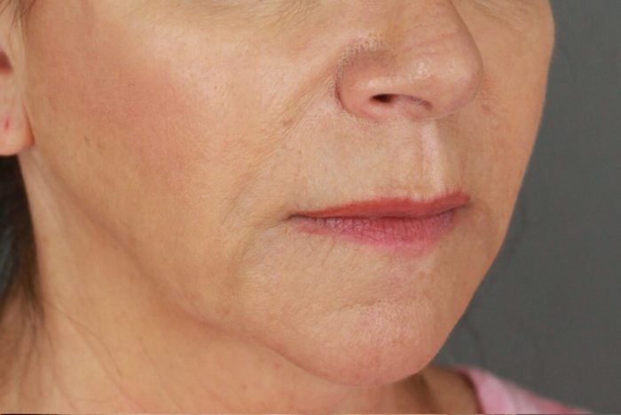 Case--4062 | Before Lip Lift 2