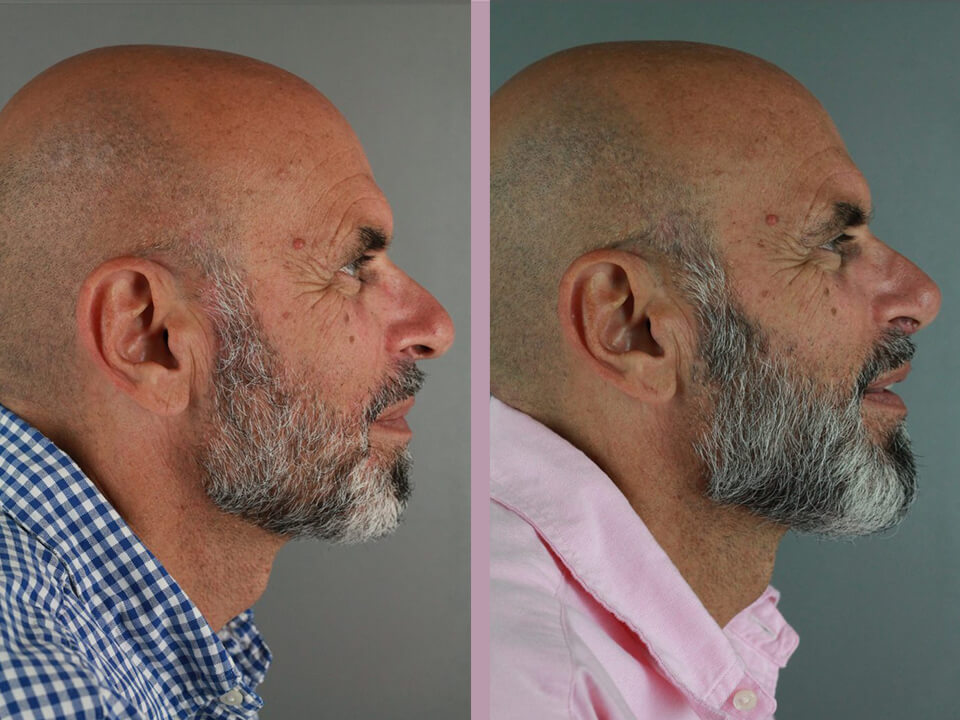 Rhinoplasty - Before and After Patient Results - 2