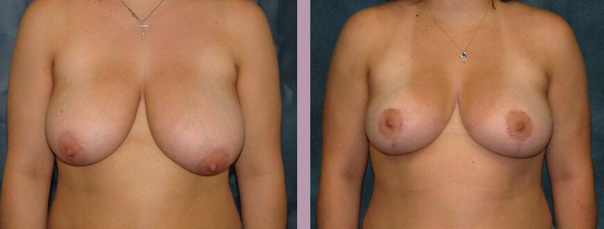 Breast Reduction - Before and After Patient Results - 1