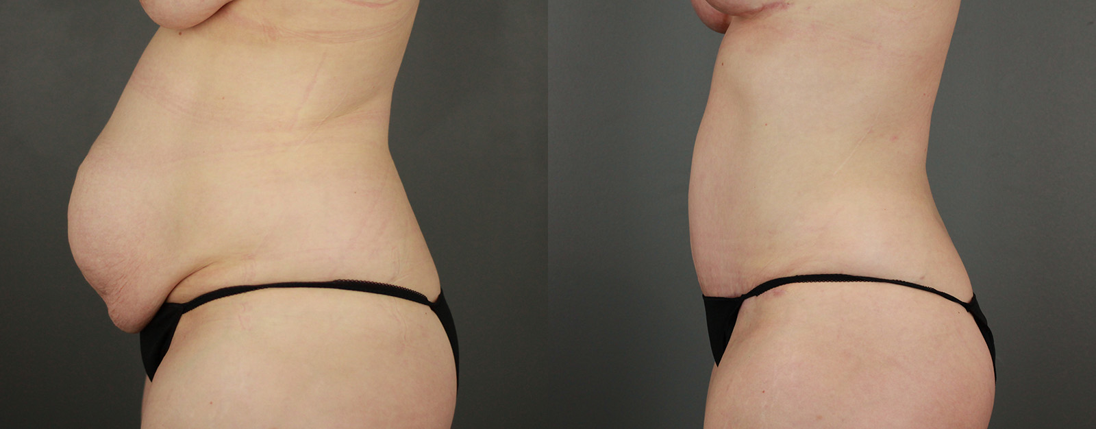 Case--7504 | Before and After Liposuction Procedures 3