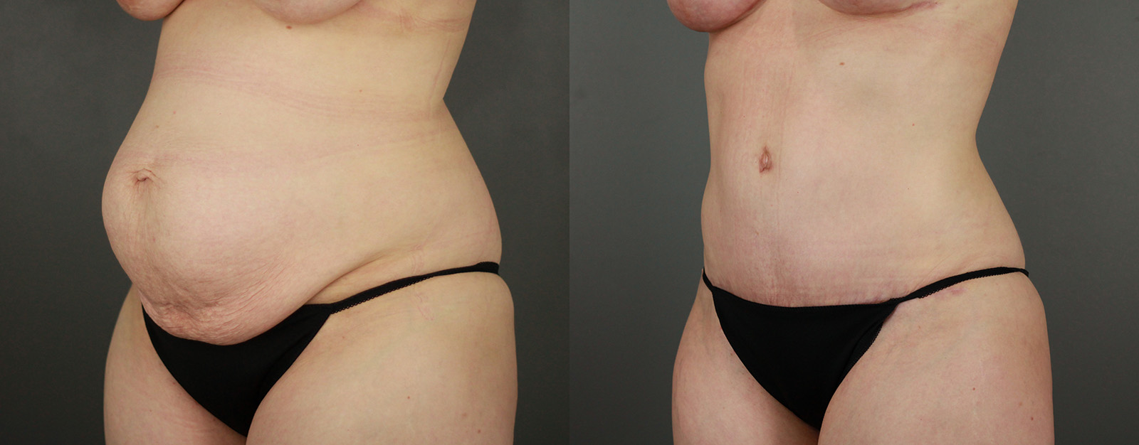 Case--9828 | Before and After Tummy Tuck 2