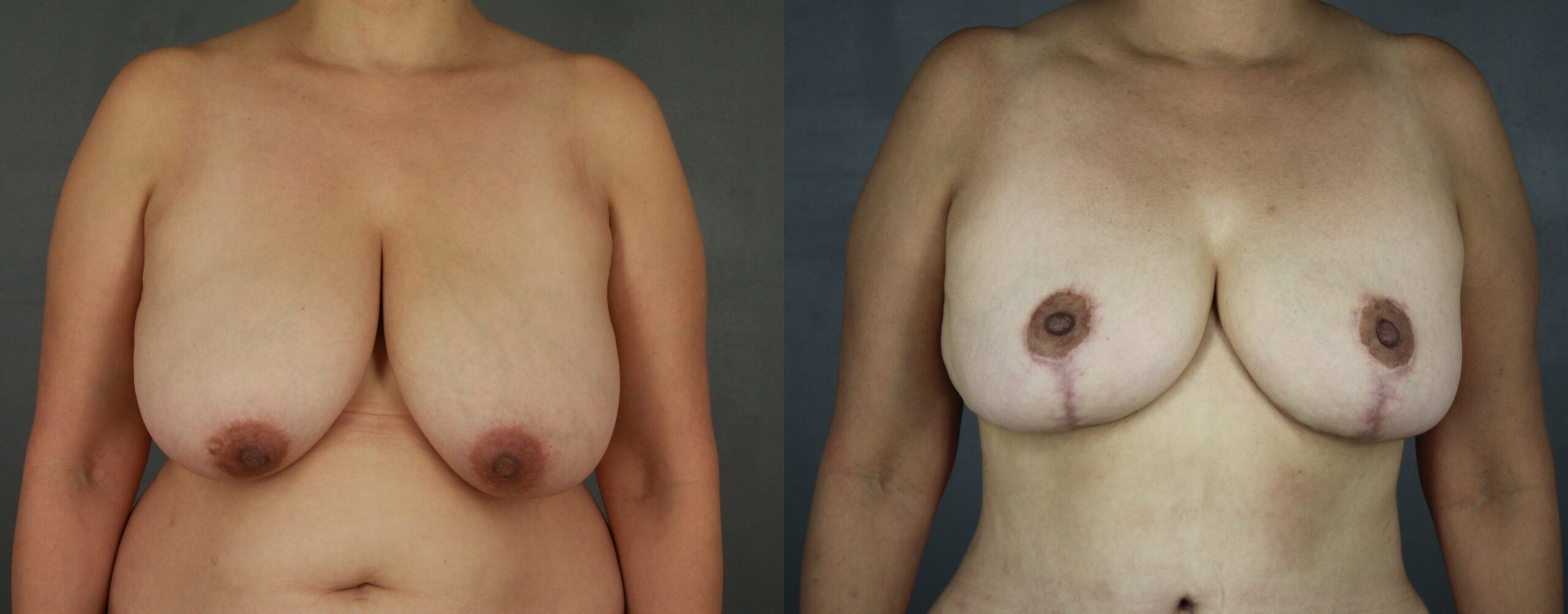 Case--8796 | Before and After Breast Reduction