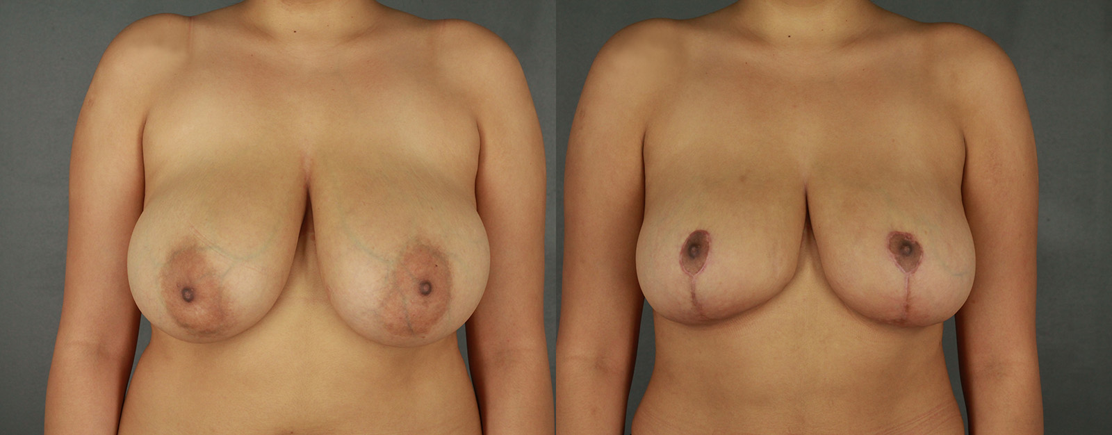 Case--2187 | Before and After Breast Reduction