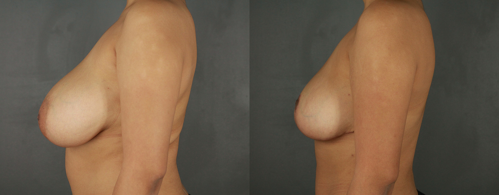 Case--2187 | Before and After Breast Reduction 3