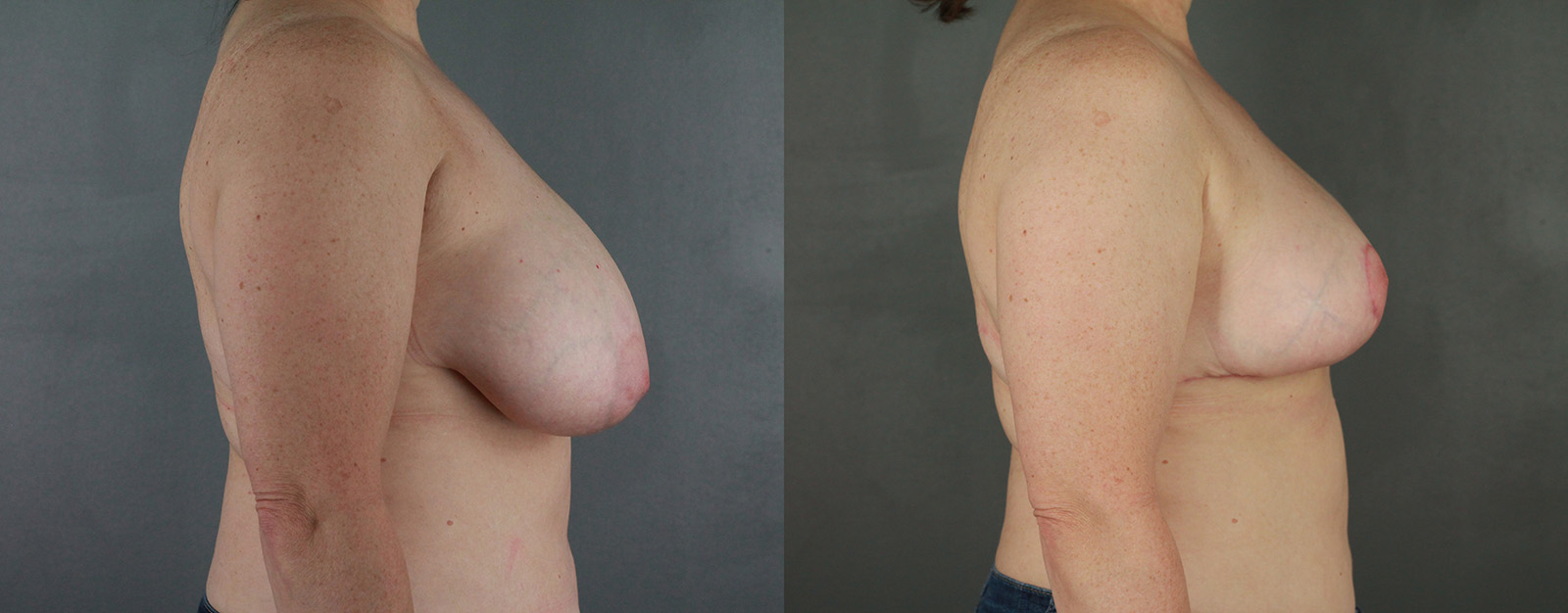Case--2581 | Before and After Breast Reduction 2