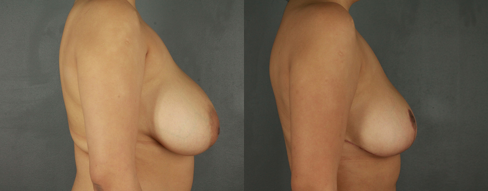 Case--2187 | Before and After Breast Reduction 2