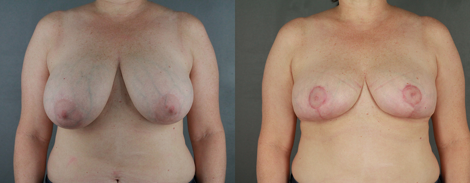 Case--2581 | Before and After Breast Reduction