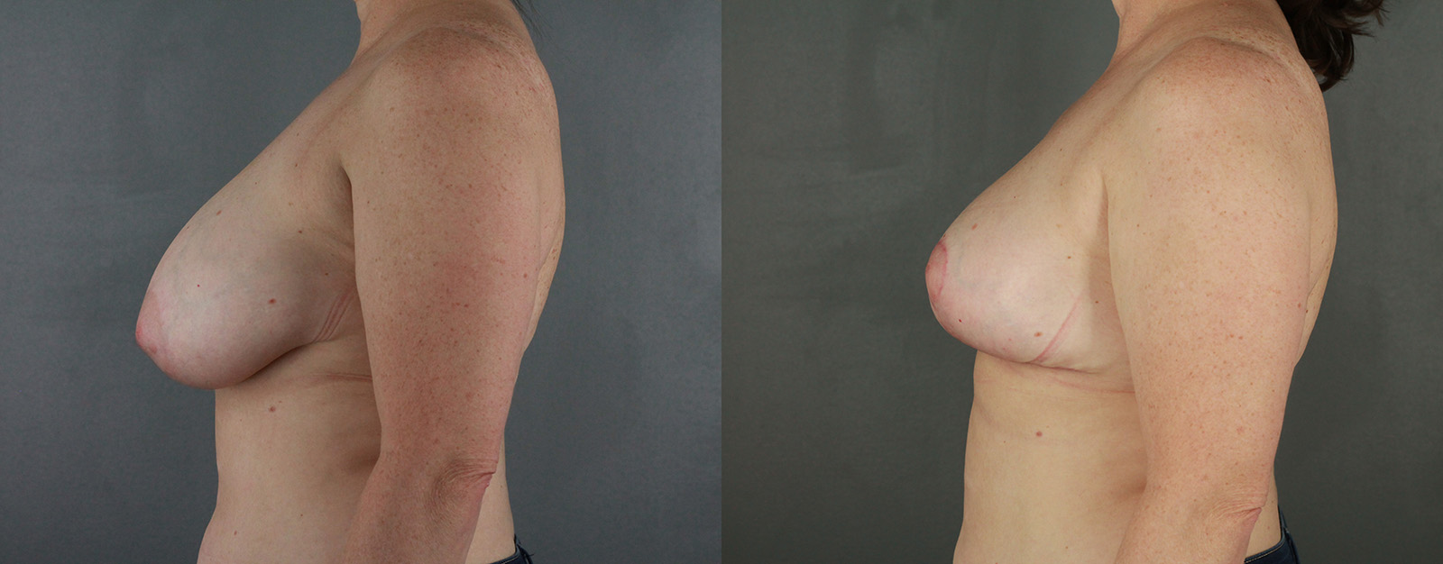 Case--2581 | Before and After Breast Reduction 3