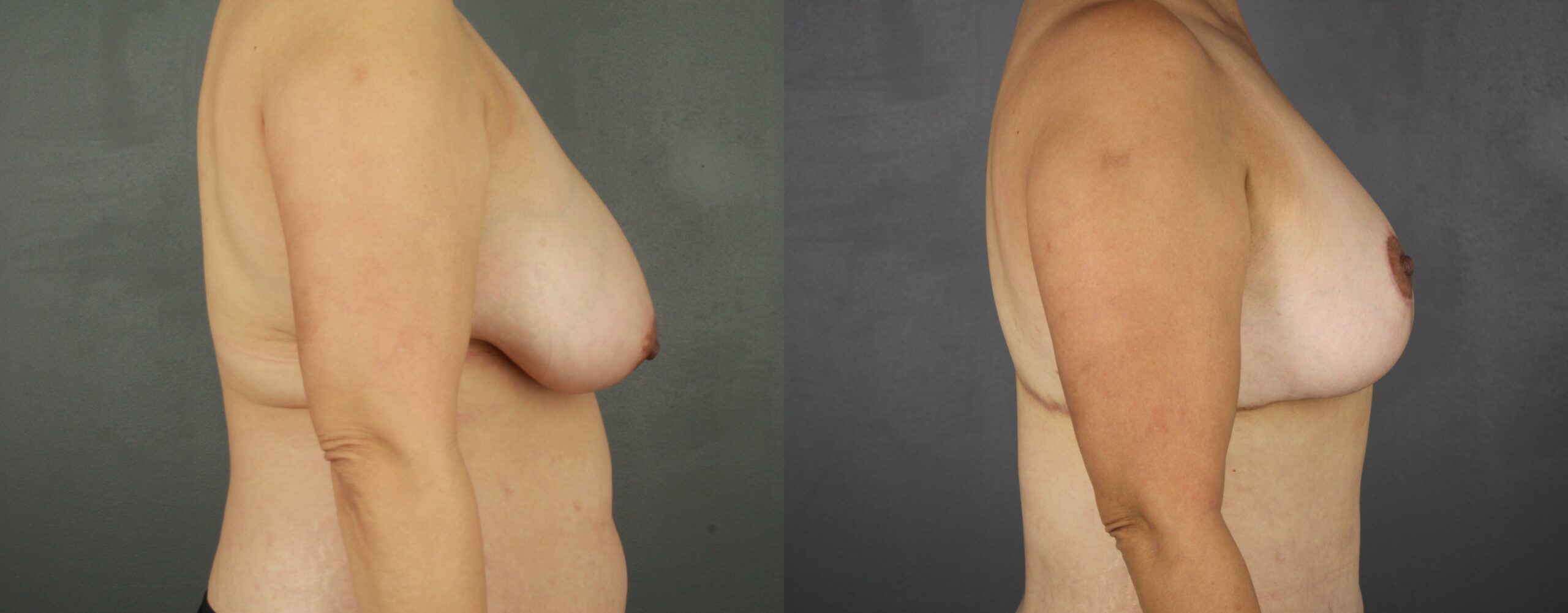 Case--8796 | Before and After Breast Reduction 2