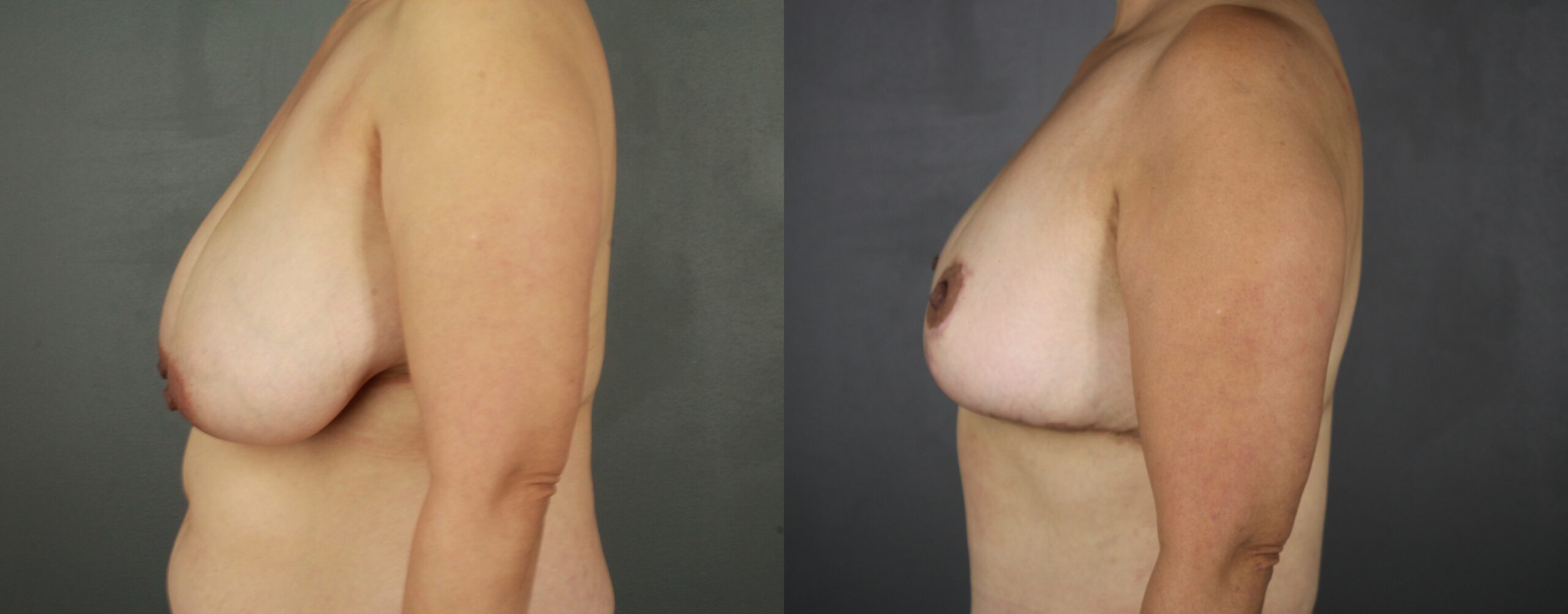 Case--8796 | Before and After Breast Reduction 3