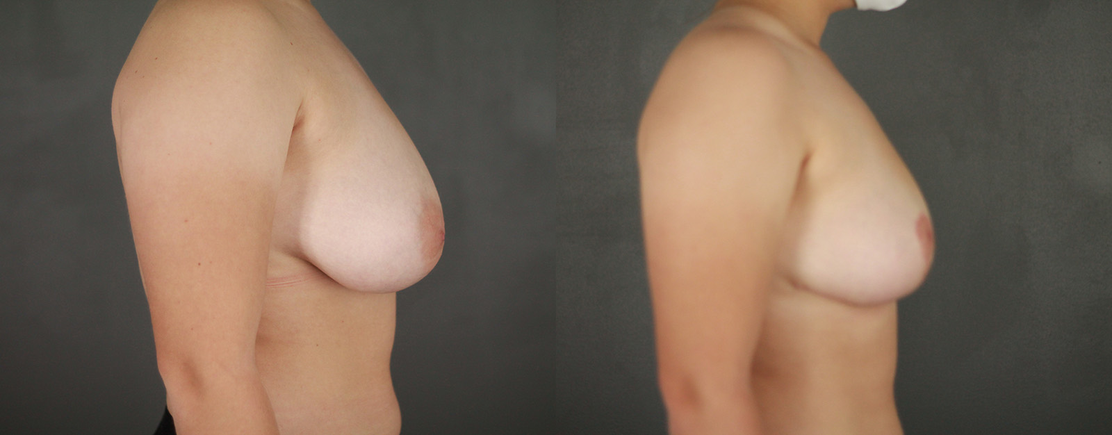 Case--2875 | Before and After Breast Reduction 3