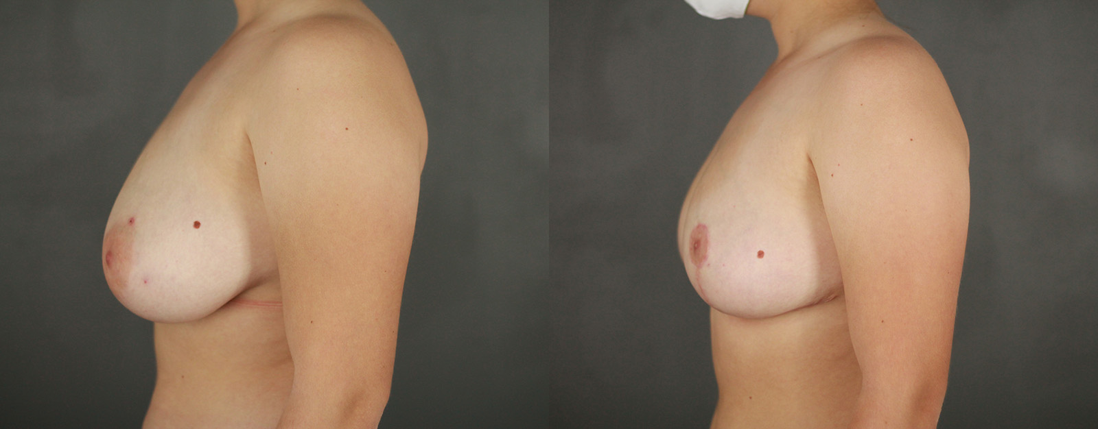 Case--2875 | Before and After Breast Reduction 2