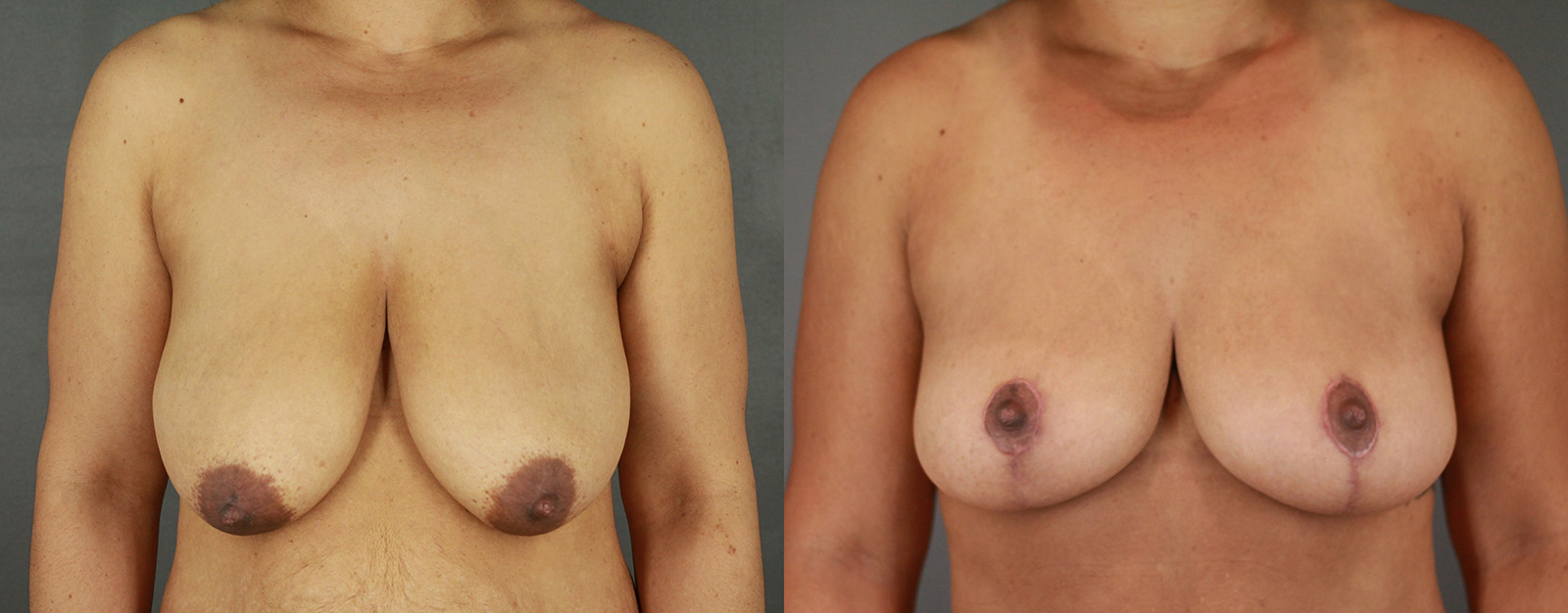 Case--1984 | Before and After Breast Reduction