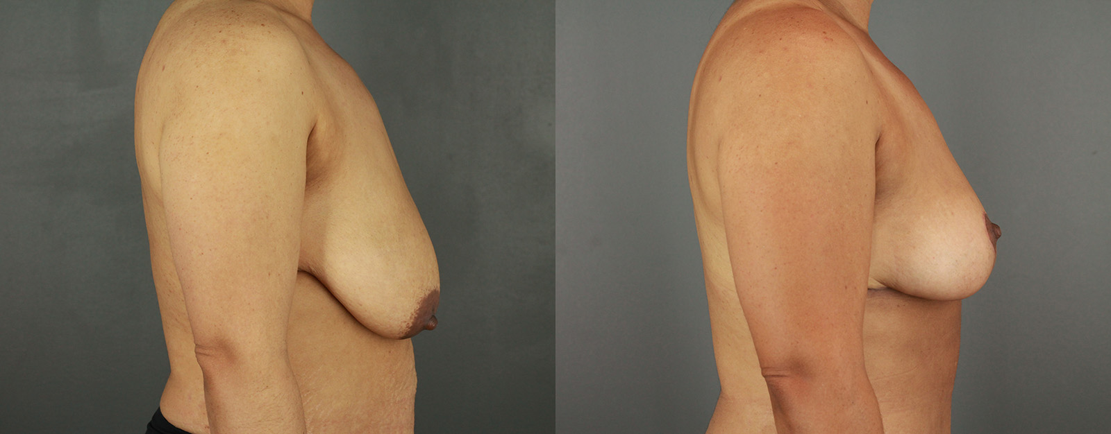 Case--1984 | Before and After Breast Reduction 3