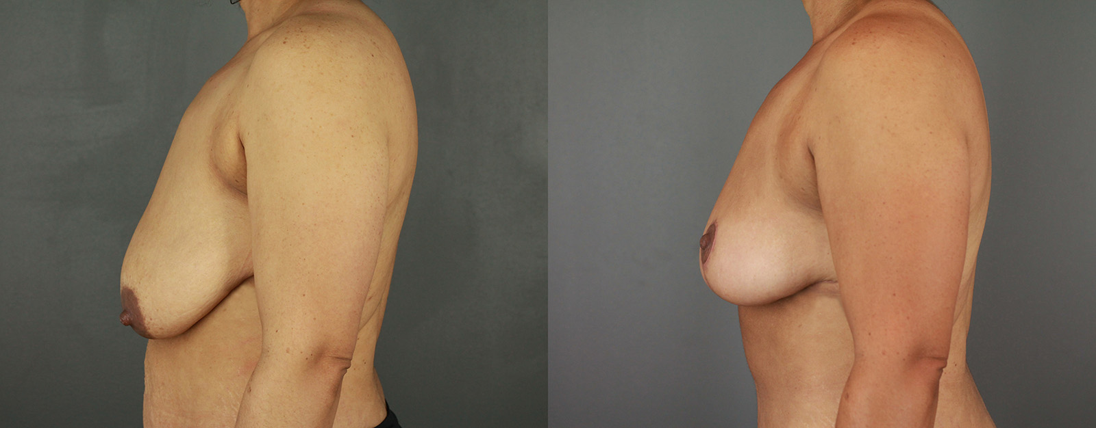 Case--1984 | Before and After Breast Reduction 2