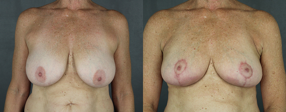 Case--3474 | Before and After Breast Reduction