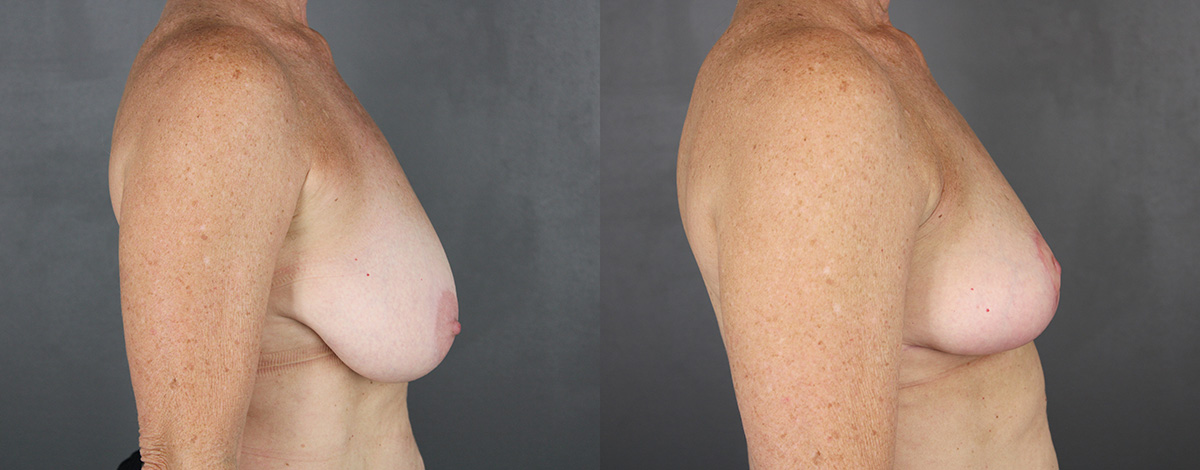 Case--3474 | Before and After Breast Reduction 3