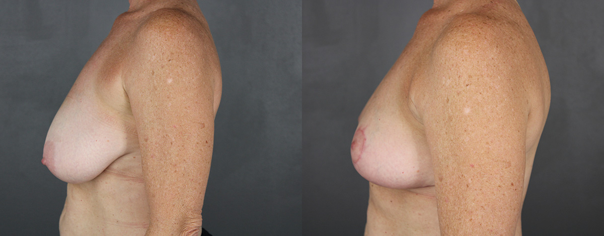 Case--3474 | Before and After Breast Reduction 2