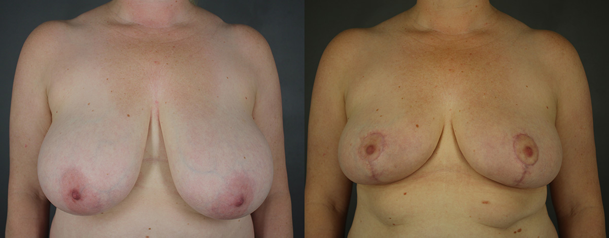 Case--4798 | Before and After Breast Reduction
